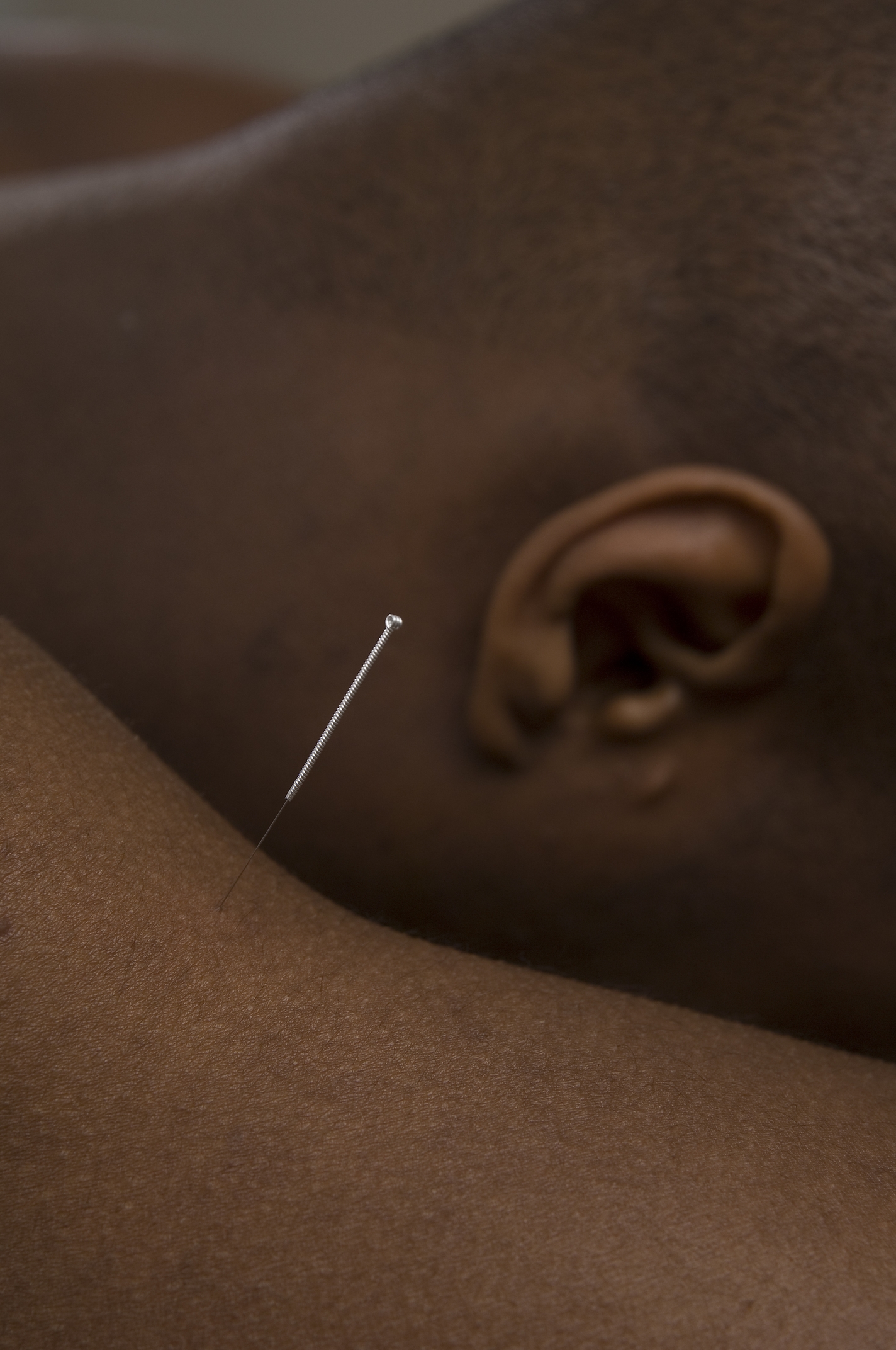 Acupuncture needle in situ