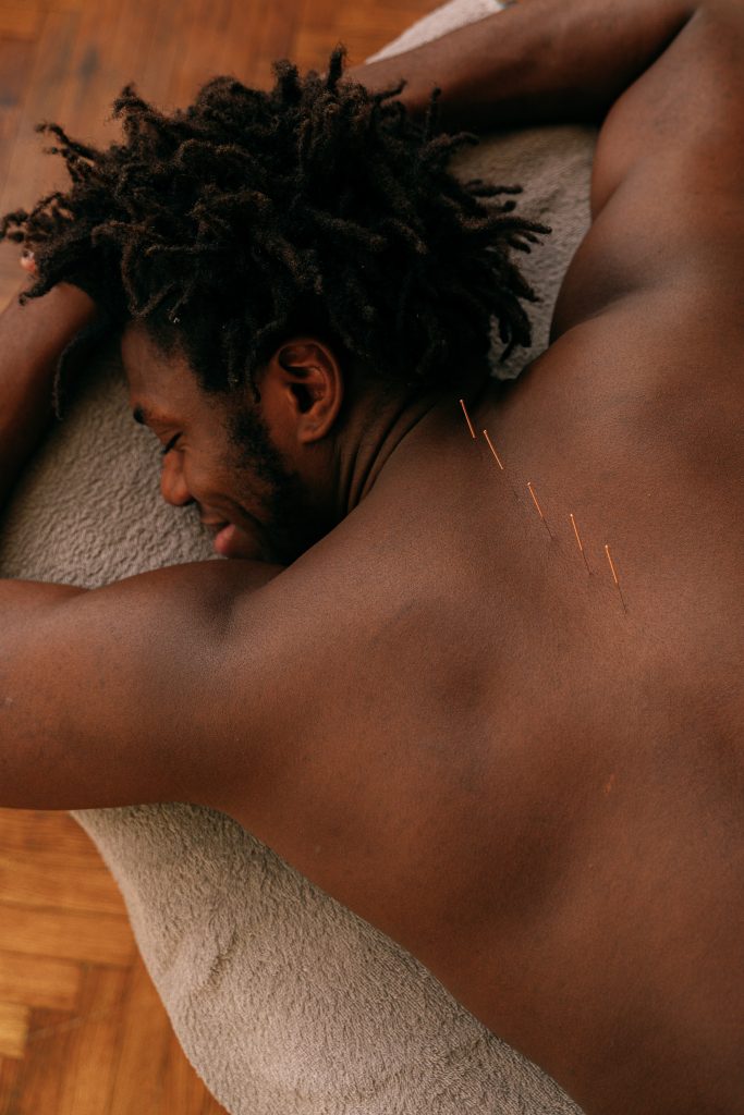 Acupuncture needles in a patient's back